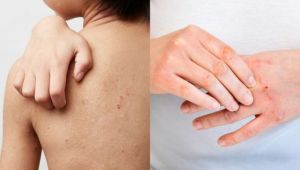 Atopik cilt nasıl tedavi edilir? Atopik cilt düzelir mi? Atopik cilt olduğunu nasıl anlarız? Atopik dermatit hangi krem iyi gelir?