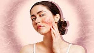 How is atopic skin treated? Can atopic skin improve? How do we know it's atopic skin? Which cream is good for atopic dermatitis?